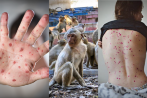 Bélgica se convierte en el primer país en ordenar cuarentena obligatoria por la viruela del mono